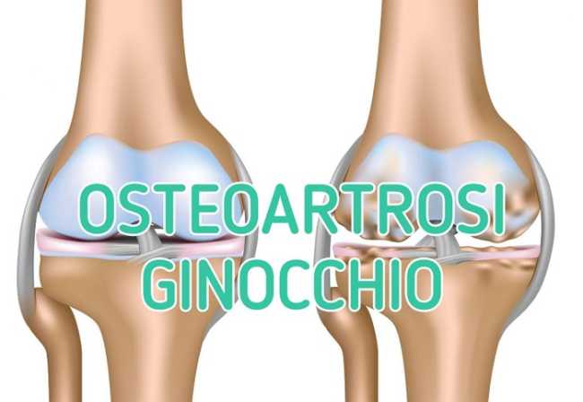 OSTEOARTROSI GINOCCHIO