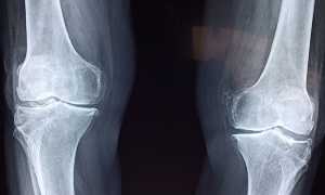 knee 2253047 960 720