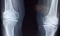 knee 2253047 960 720