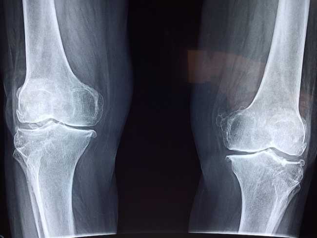 knee 2253047 960 720