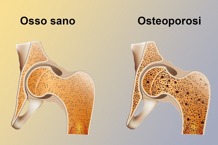 Ad Omegna si parla di osteoporosi con il Dottor Fabio Di Stefano